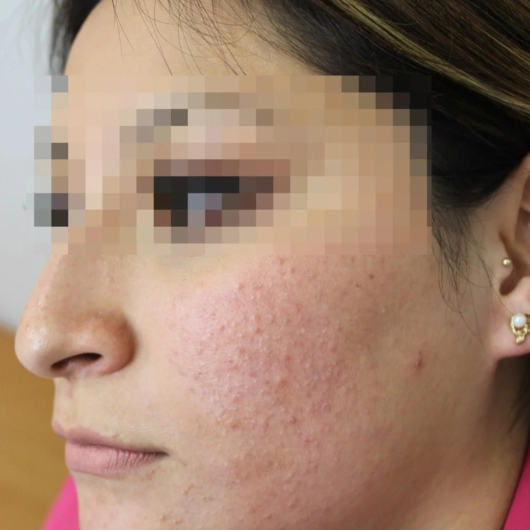 Before acne treatment