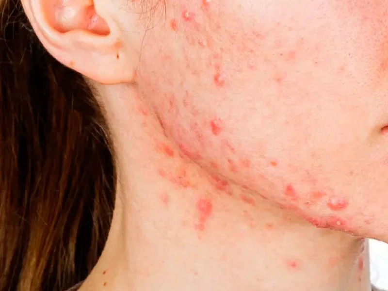 Acne treatment in Puebla