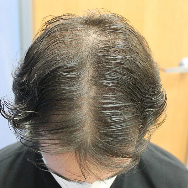 Before alopecia treatment
