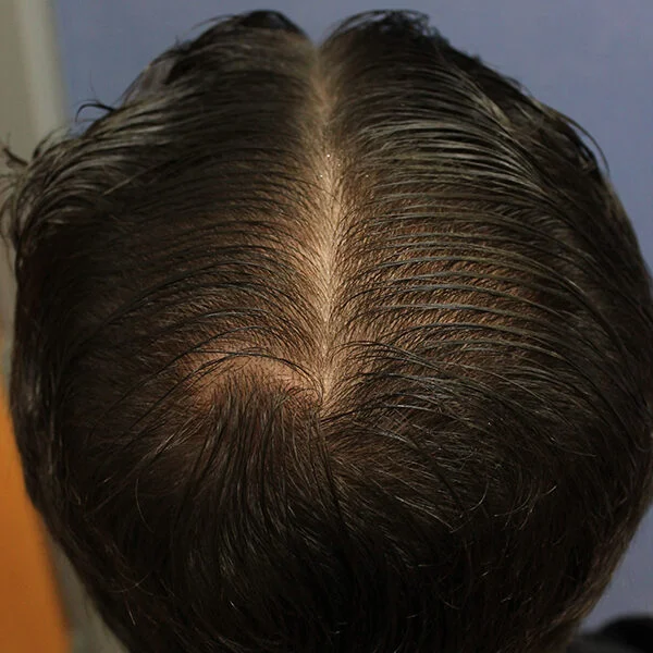 After alopecia treatment