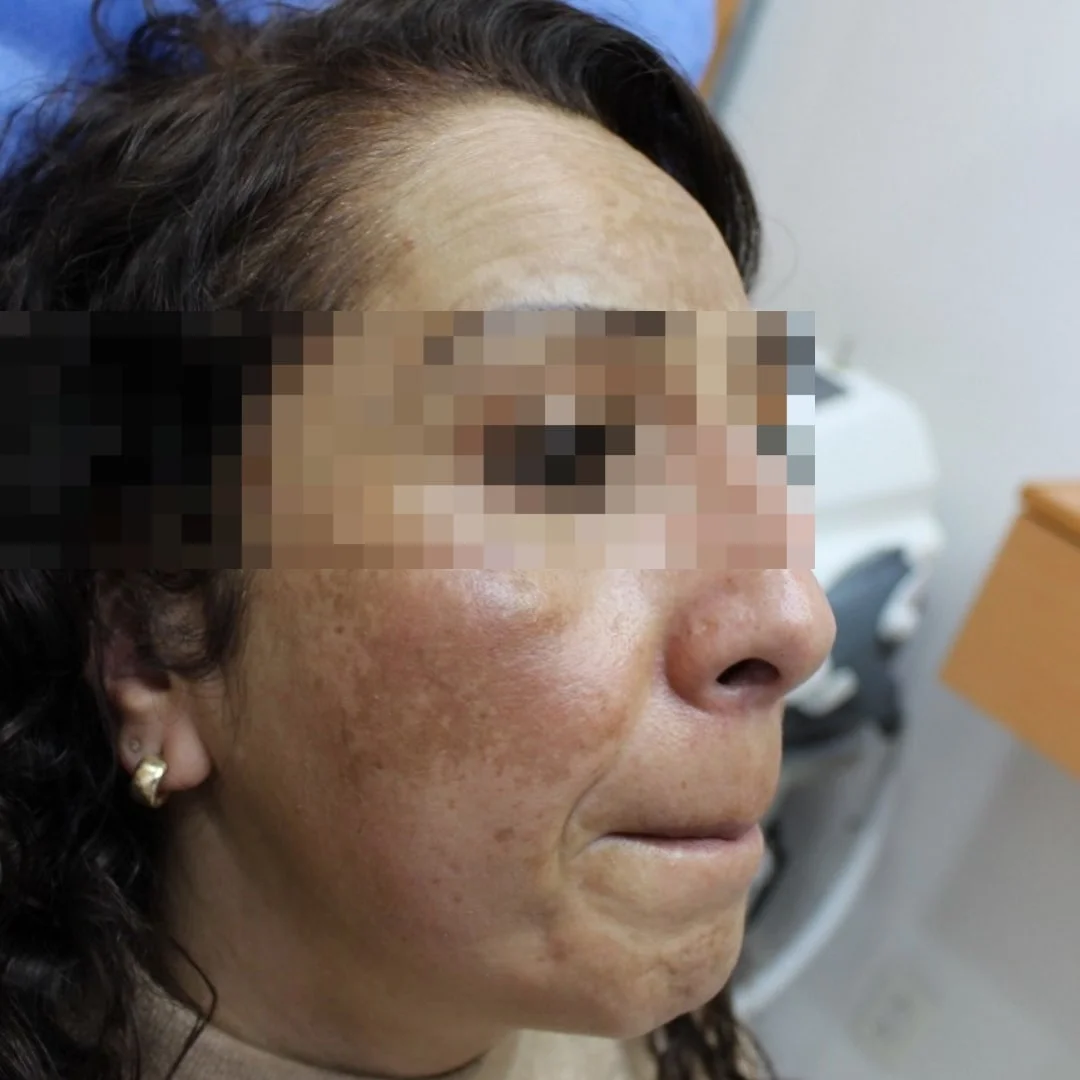 Before spot treatment