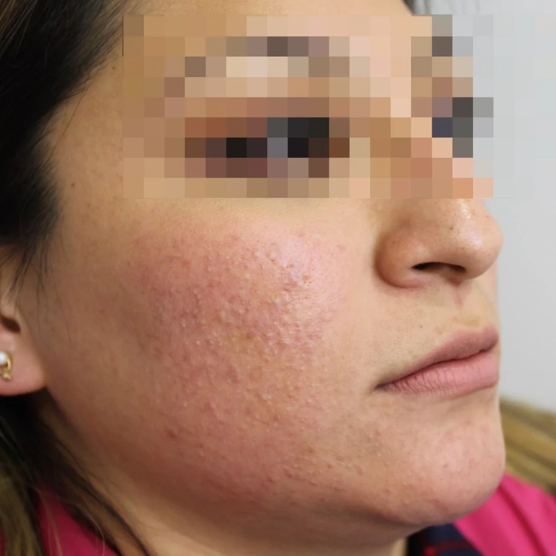 Before dermatological treatment