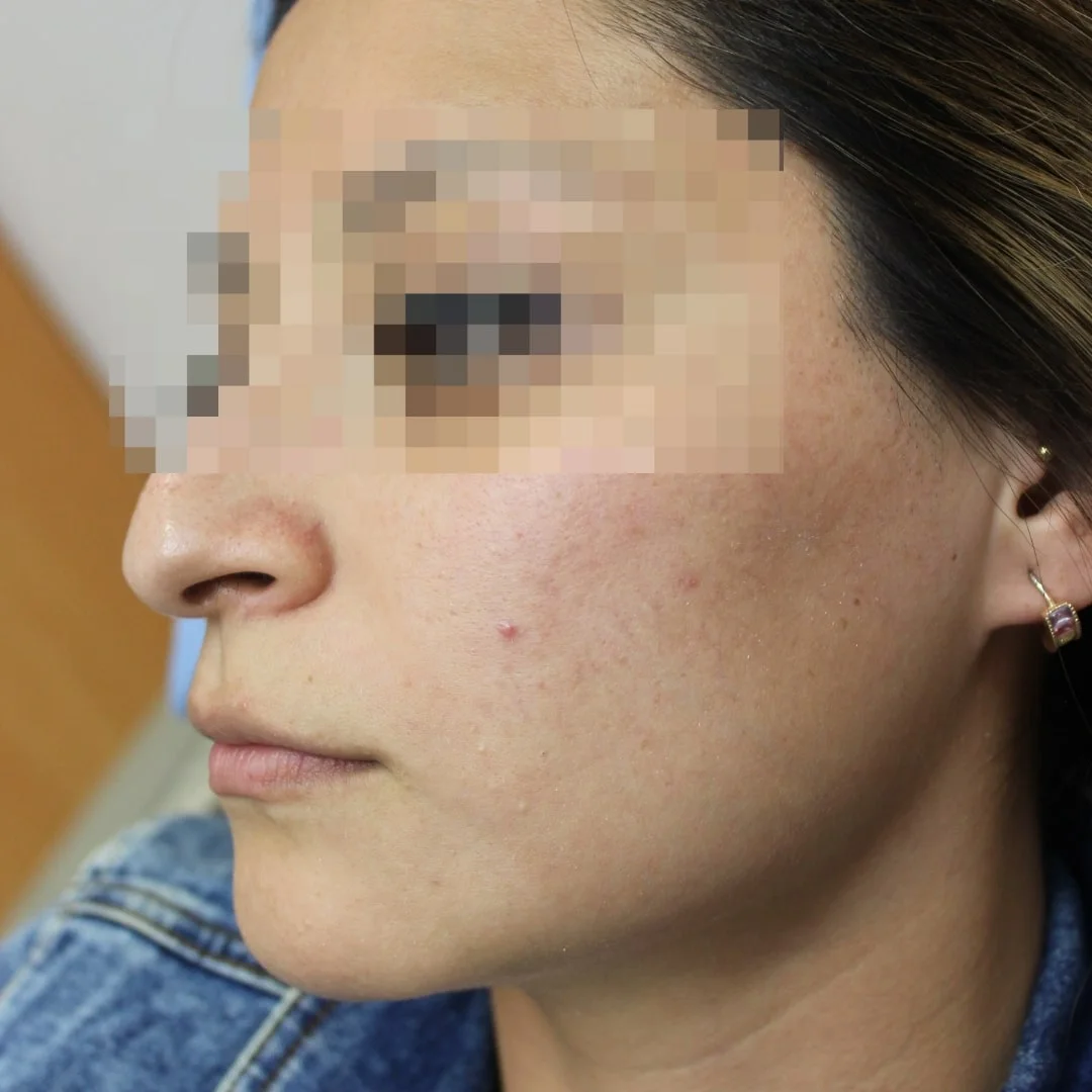 After acne treatment