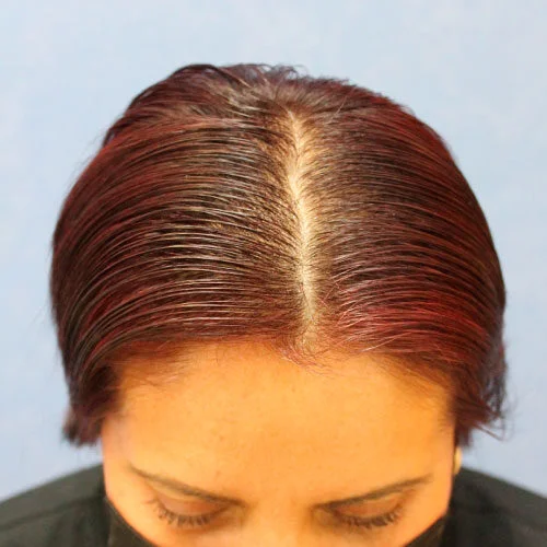 After female alopecia