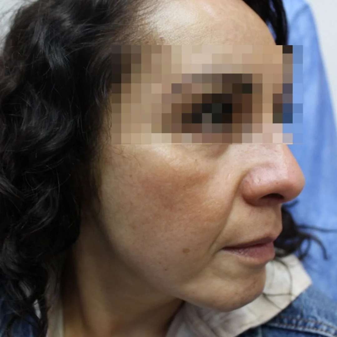 After spot treatment