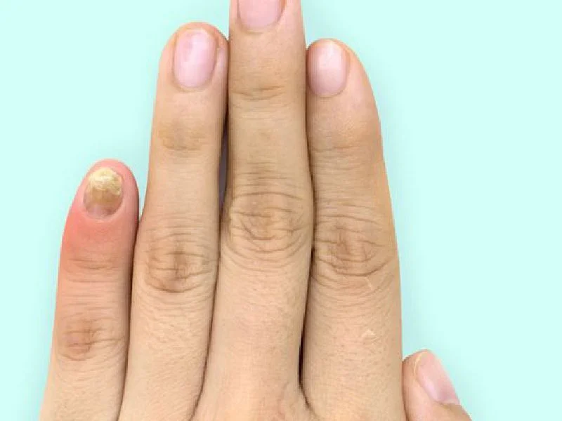 Nail diseases Puebla