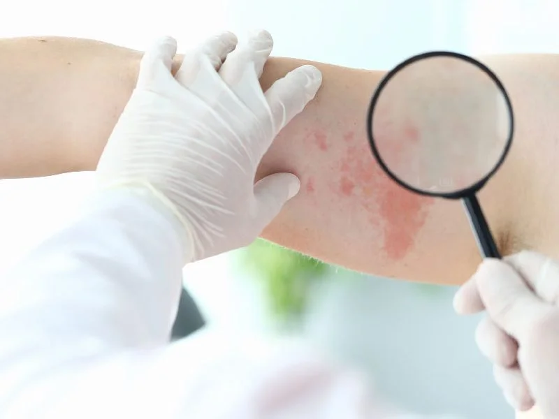 Skin and nail fungus Puebla