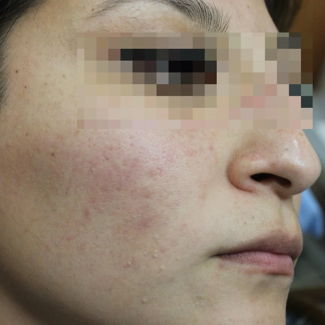 After dermatological treatment