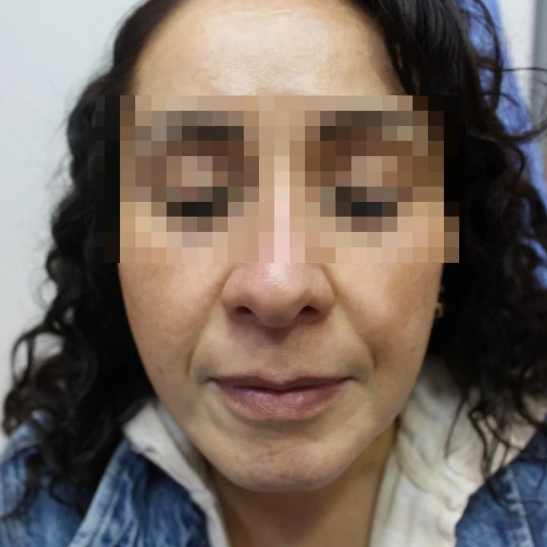 After spots hyperpigmentation