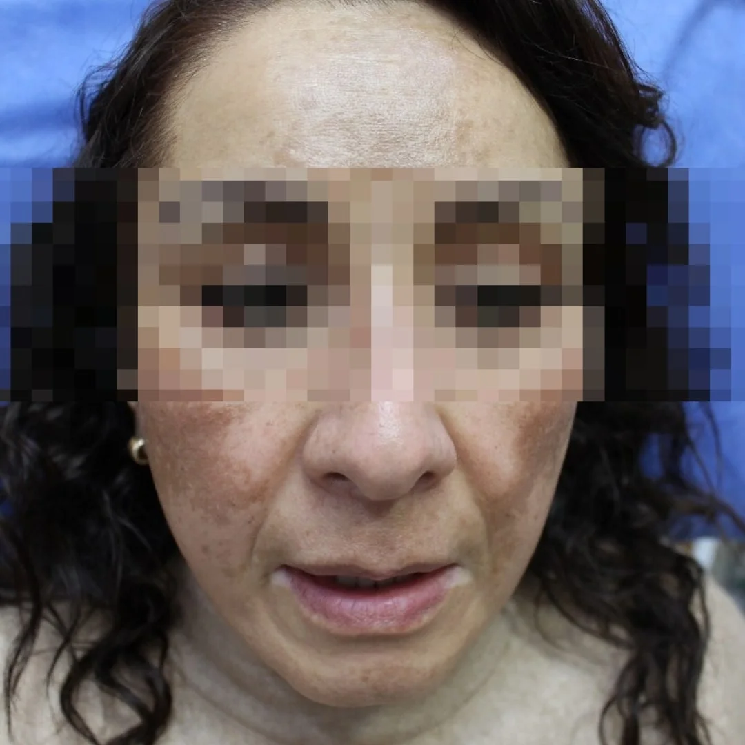 Before spots hyperpigmentation