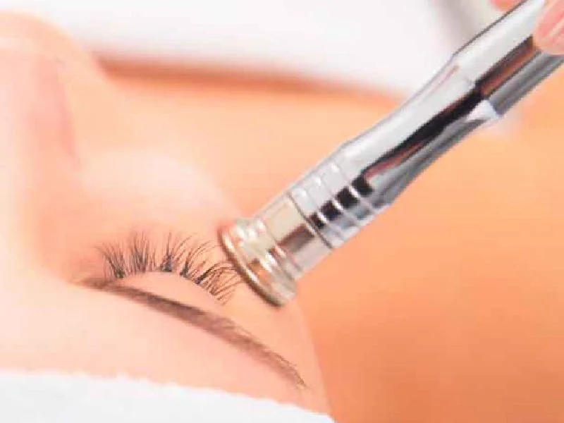 Microdermabrasion Puebla