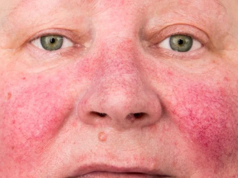 Rosacea treatment in Puebla
