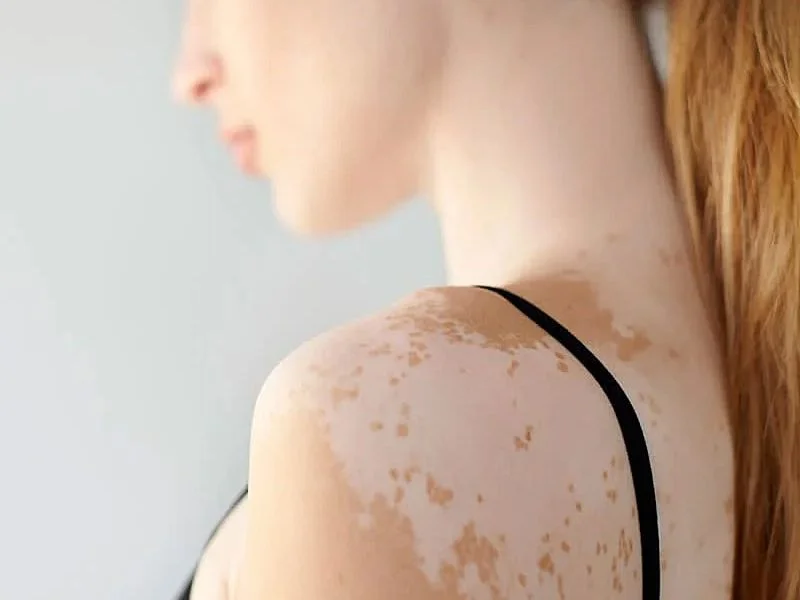 Vitiligo treatment in Puebla